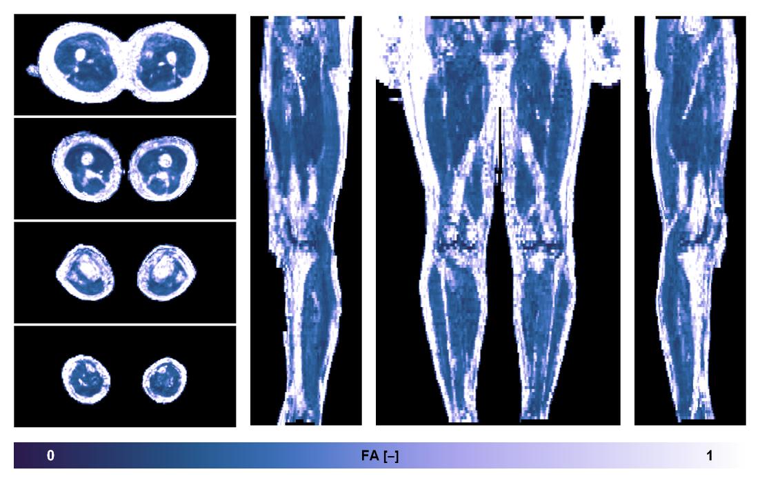 IVIM corrected whole leg muscle fractional anisotropy obtained from diffusion tensor imaging.